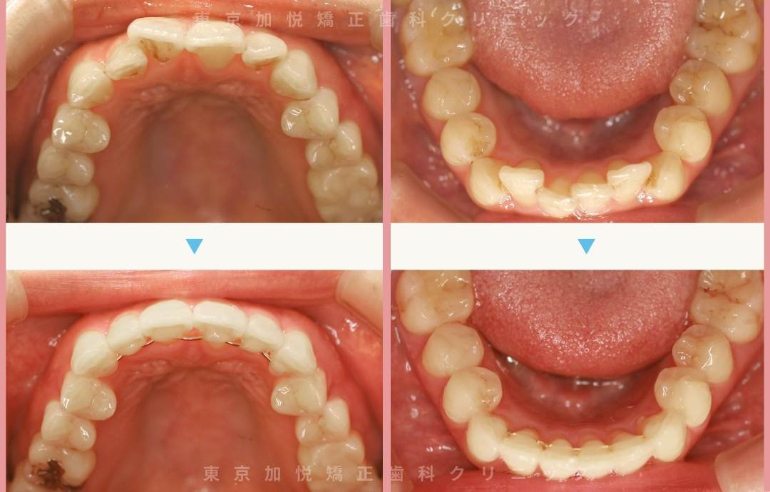 叢生の症例。上下前歯のみを矯正した写真