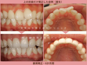 上の前歯だけ矯正した症例（叢生）