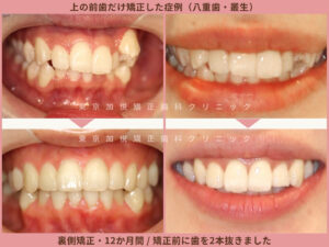 抜歯後に上の前歯だけ矯正した症例写真