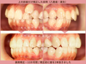 抜歯後に上の前歯だけ矯正した症例写真