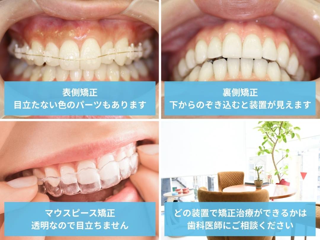 表側矯正
目立たない色のパーツもあります
裏側矯正
下からのぞき込むと装置が見えます
マウスピース矯正
透明なので目立ちません
どの装置で矯正治療ができるかは
歯科医師にご相談ください