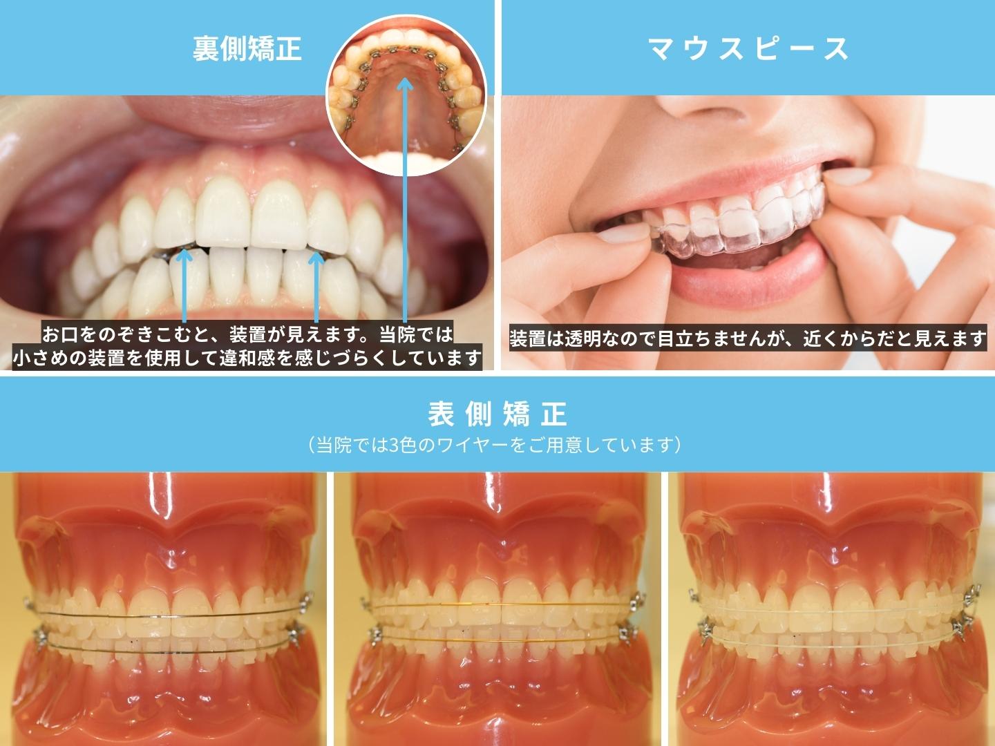 矯正装置の写真（裏側矯正・マウスピース矯正・表側矯正）