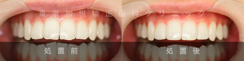 歯の形態修正  処置前と後の比較写真