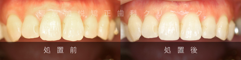 歯の形態修正、処置前、処置後写真