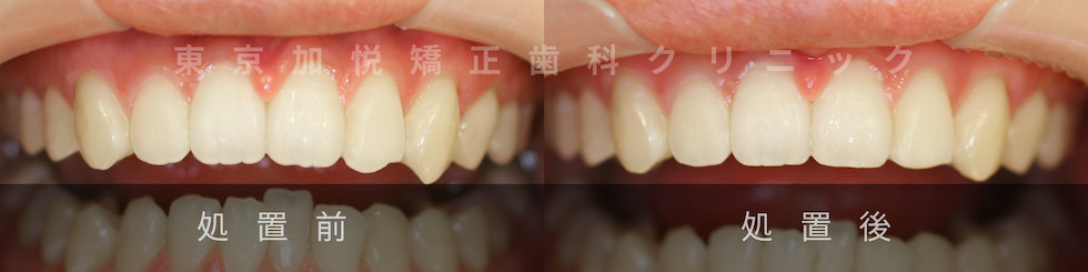 歯の形態修正。処置前処置後写真比較