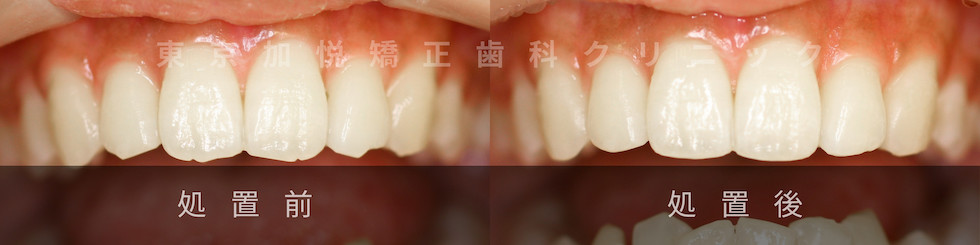 歯の形態修正。処置前処置後写真比較