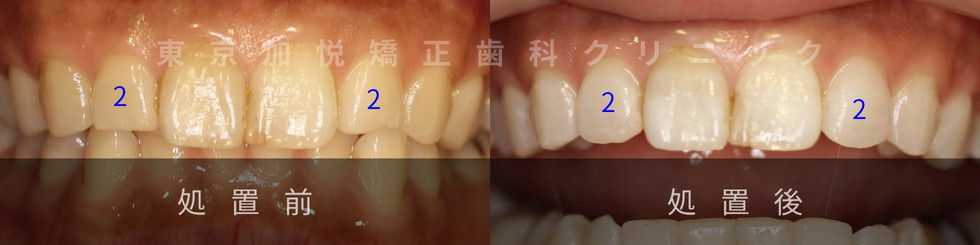 歯の形態修正。CR充填処置前処置後写真比較