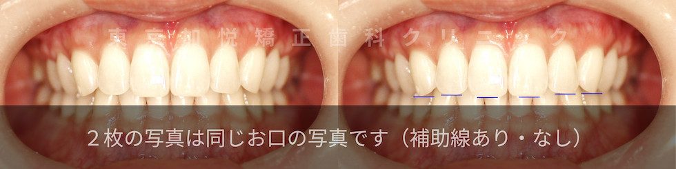 2枚の写真は同じお口です。（補助線あり・なし）