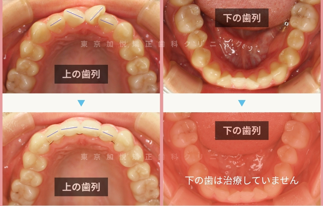 前歯の矯正前後写真（咬合面）