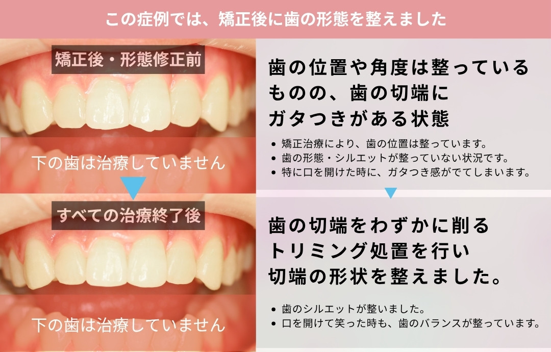 歯の形態修正前後写真