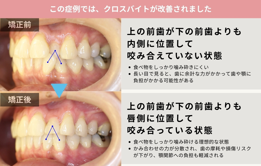 クロスバイトの治療前後拡大写真