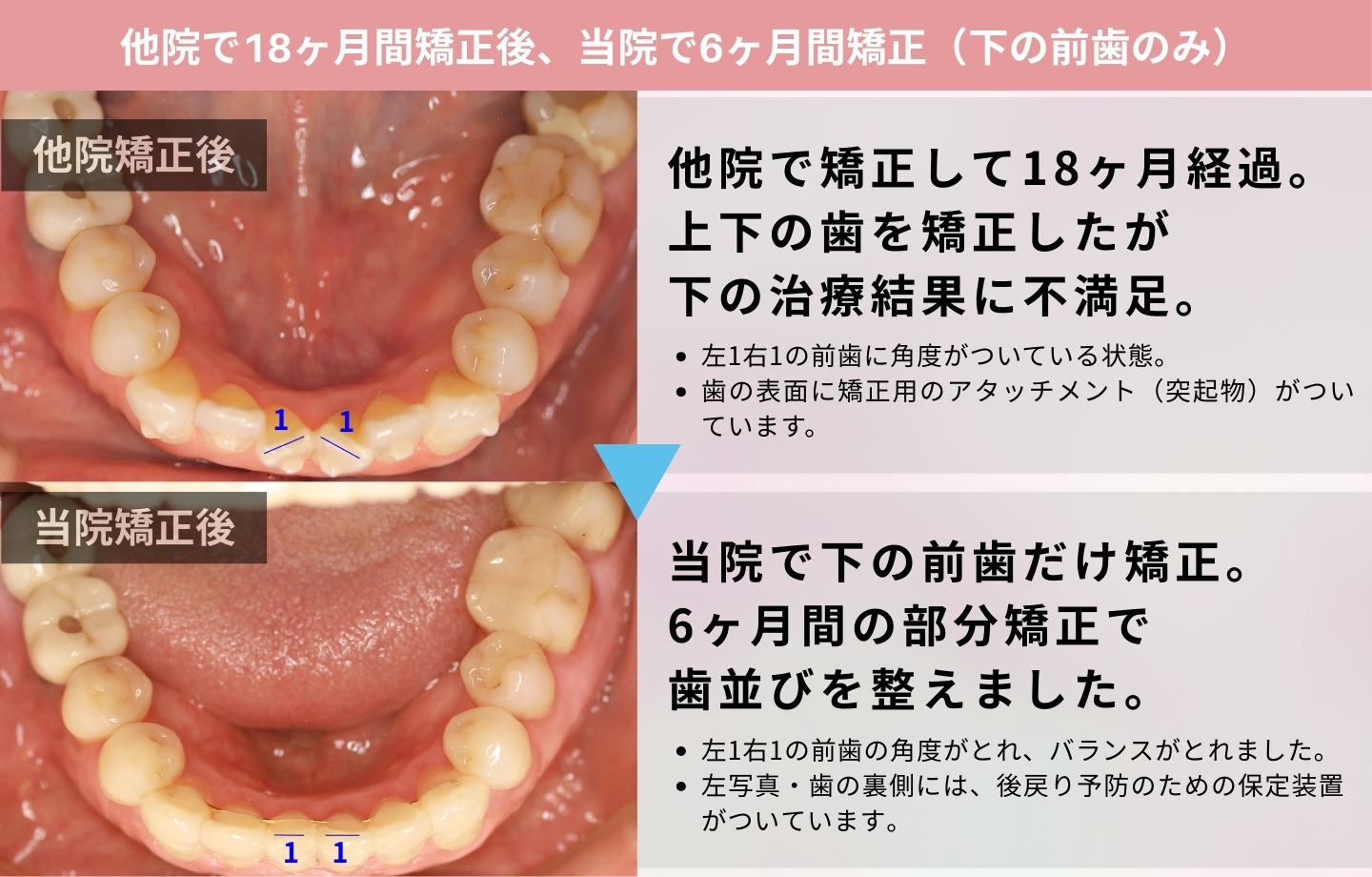 再矯正症例③ 正面から見た矯正前後の写真（下の前歯の改善）