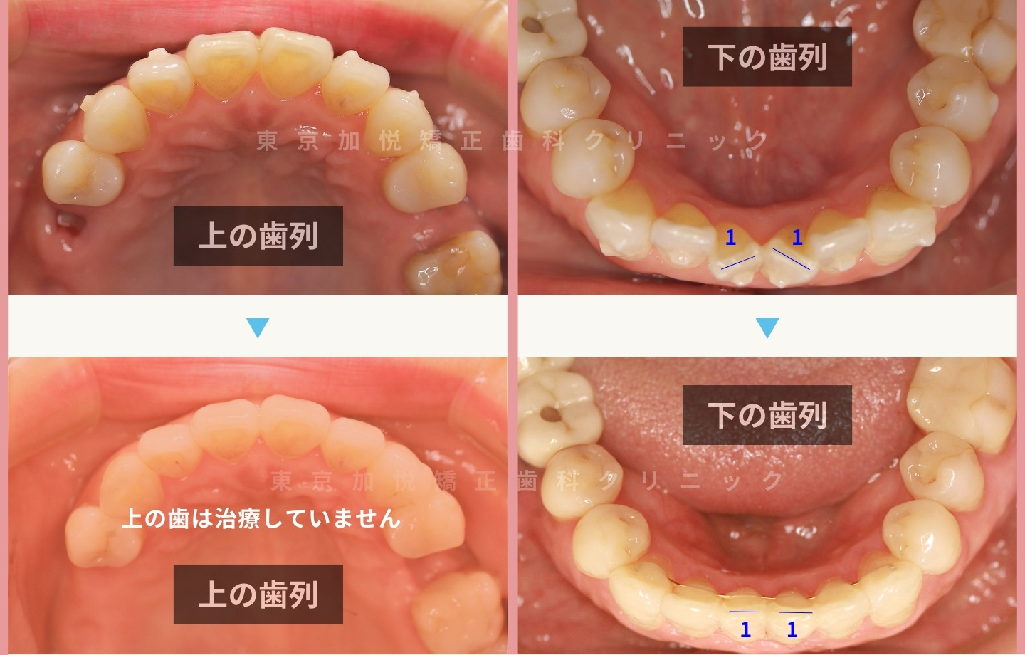 再矯正症例③ 咬合面から見た矯正前後写真 下顎の歯列改善