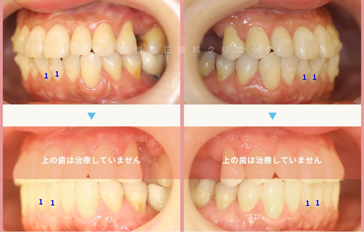 再矯正症例③ 側方から見た矯正前後写真 下顎前歯の配列改善