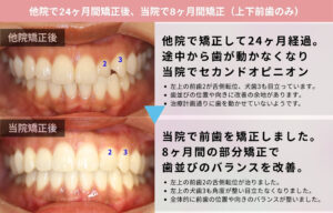 再矯正症例① 正面から見た矯正前後の歯並び写真