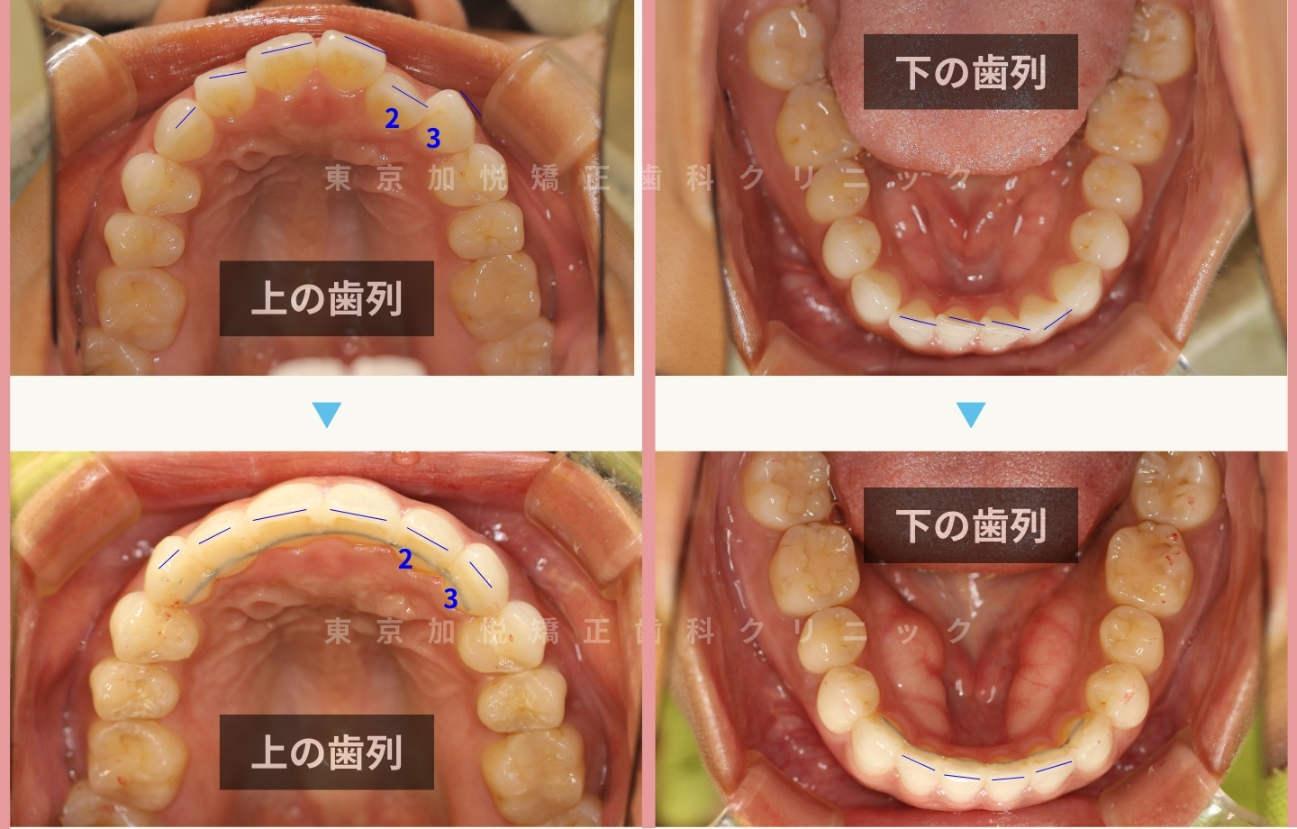 再矯正症例① 咬合面から見た矯正前後写真 歯列と切端ラインの改善