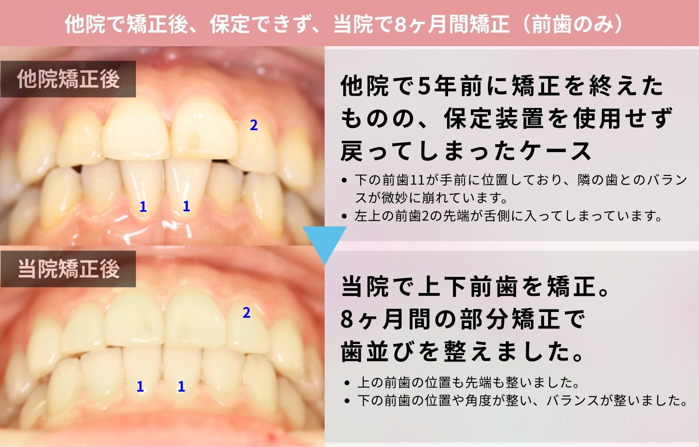 再矯正症例④ 正面から見た矯正前後の写真（後戻りの改善）