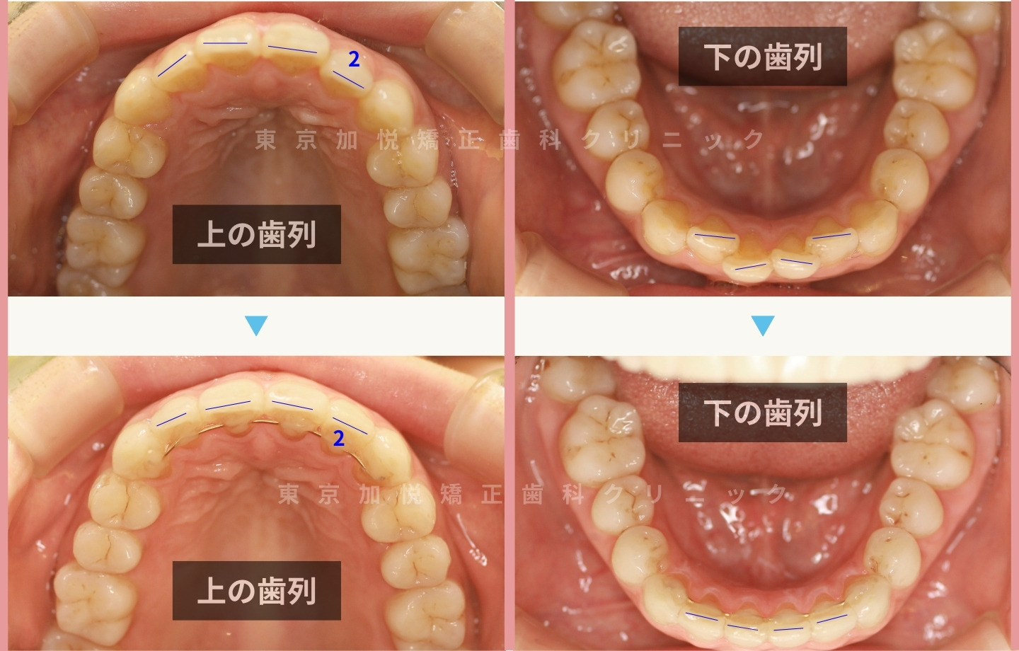 再矯正症例④ 咬合面から見た矯正前後写真 切端ラインの改善