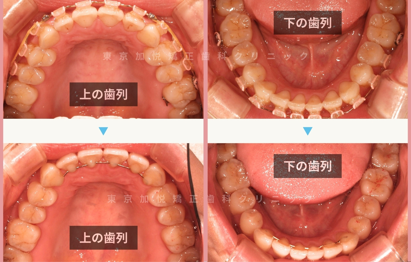 再矯正症例② 咬合面から見た矯正前後写真 歯列のバランス改善