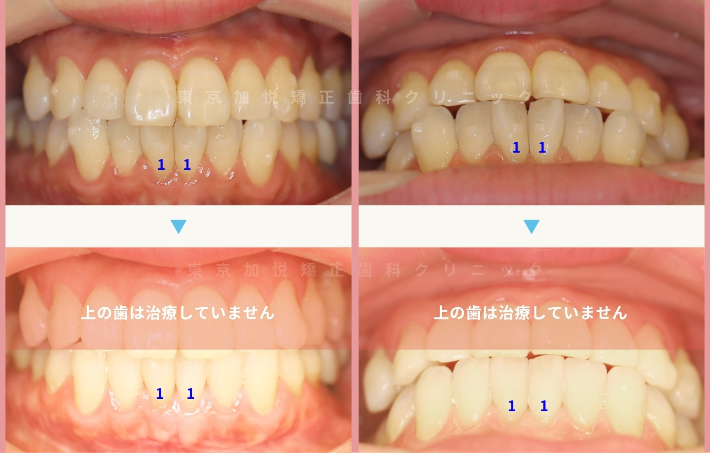 他院でインビザライン矯正後に当院でセカンドオピニオン・下前歯の裏側矯正をした症例・正面写真