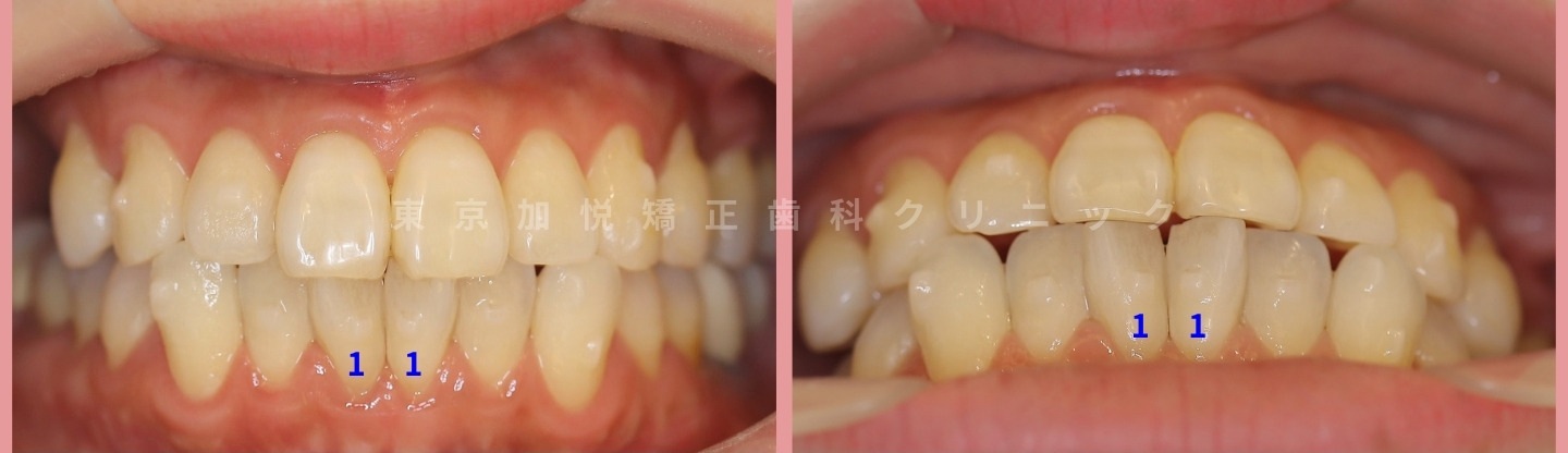 他院インビザライン15ヶ月間矯正後、当院セカンドオピニオン時のお口の写真