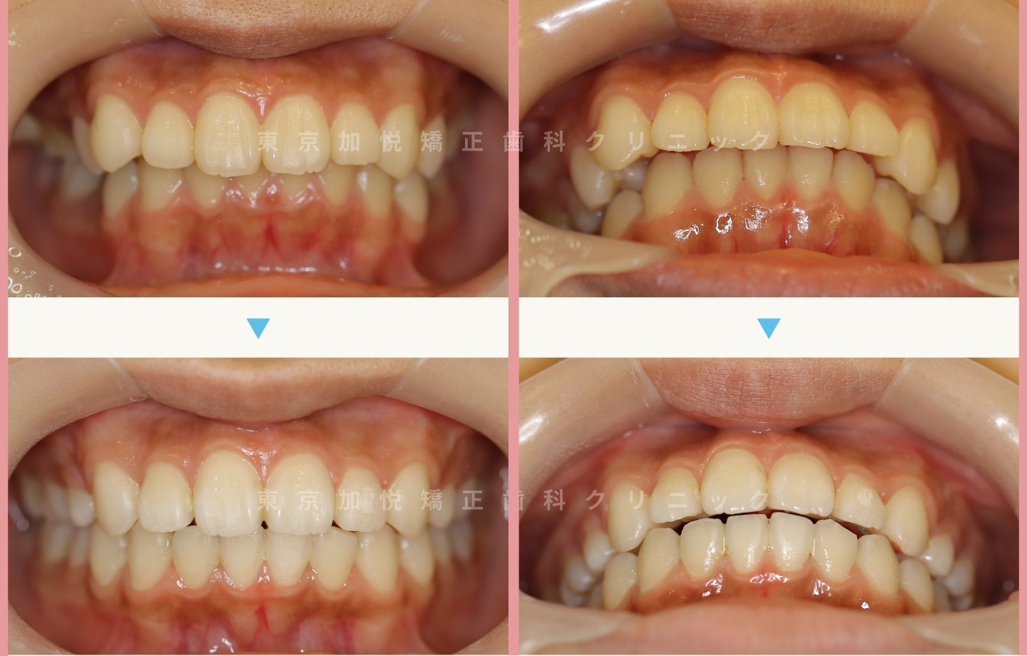 正面の全顎矯正治療前後写真