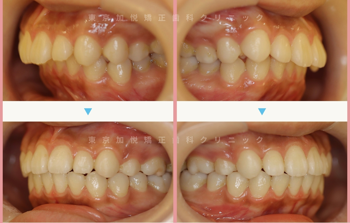 横顔の全顎矯正治療前後写真