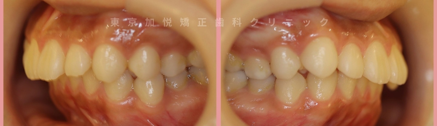 矯正前の歯列（横から）