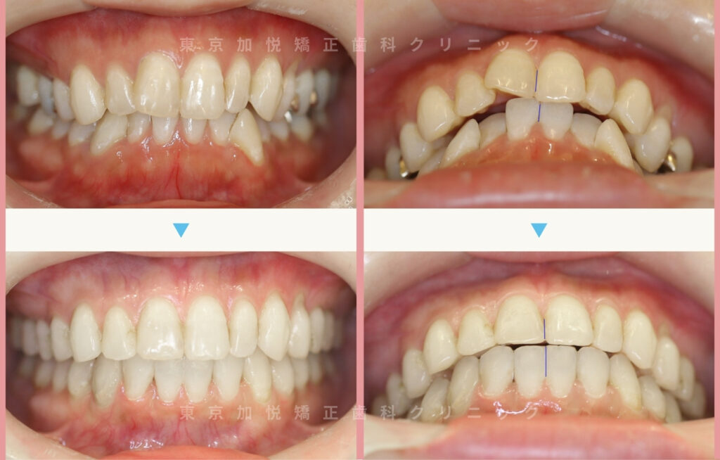 歯を抜かないで矯正した症例の正面写真（全顎矯正）