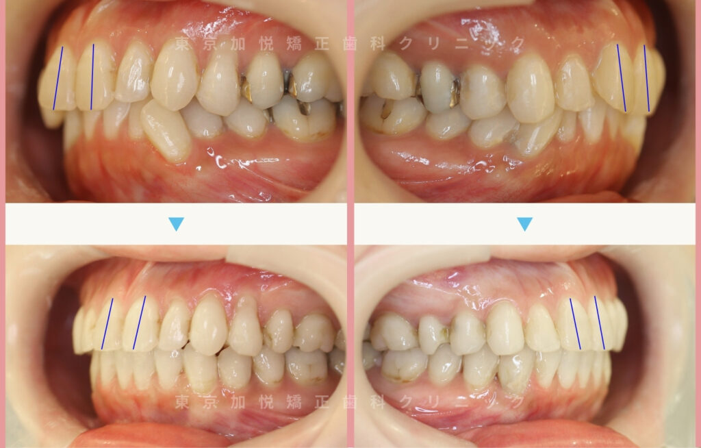 歯を抜かないで矯正した症例の横顔写真（全顎矯正）