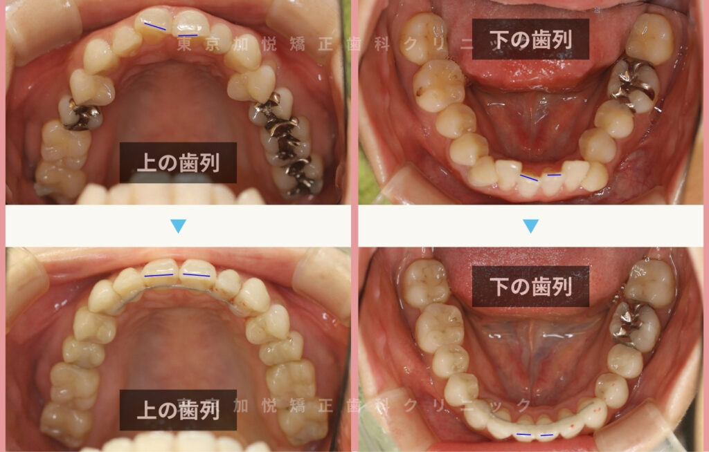 歯を抜かないで矯正した症例の咬合面写真（全顎矯正）