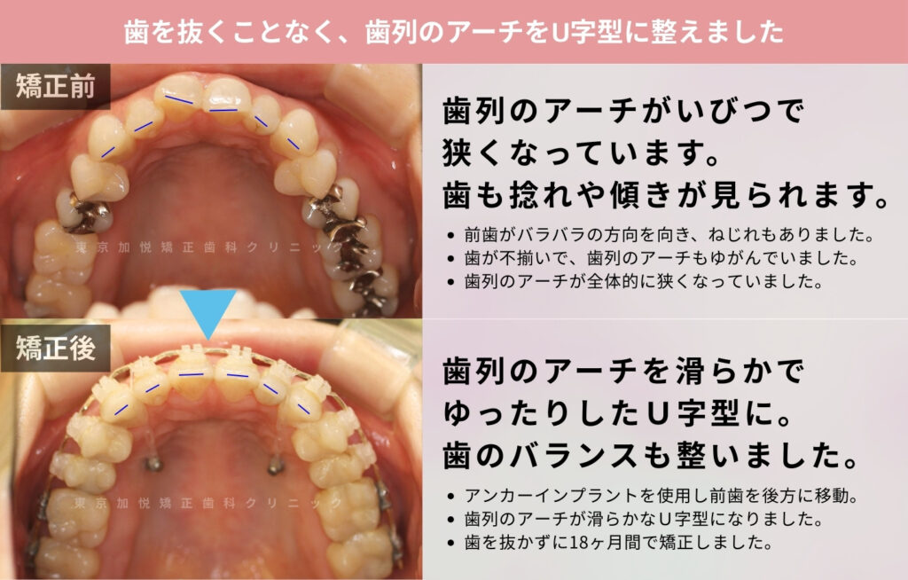 歯を抜かないで矯正した症例の咬合面写真つき症例解説画像（全顎矯正）