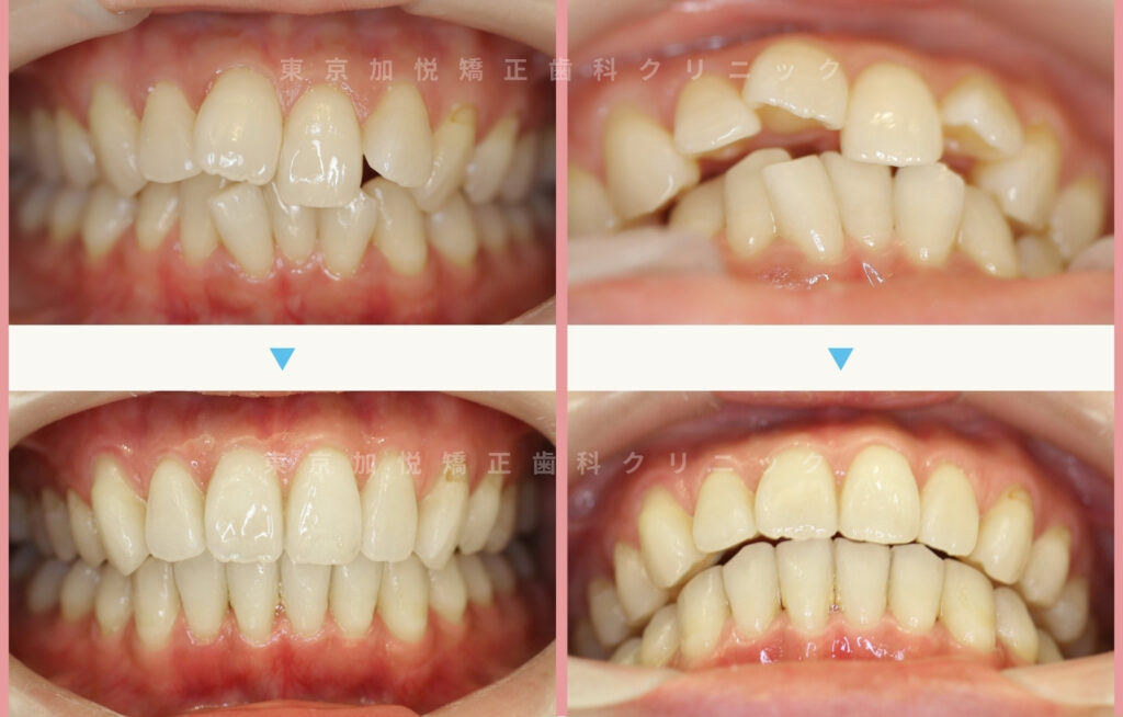 歯を抜かないで矯正した症例の正面写真（上下の前歯を矯正）