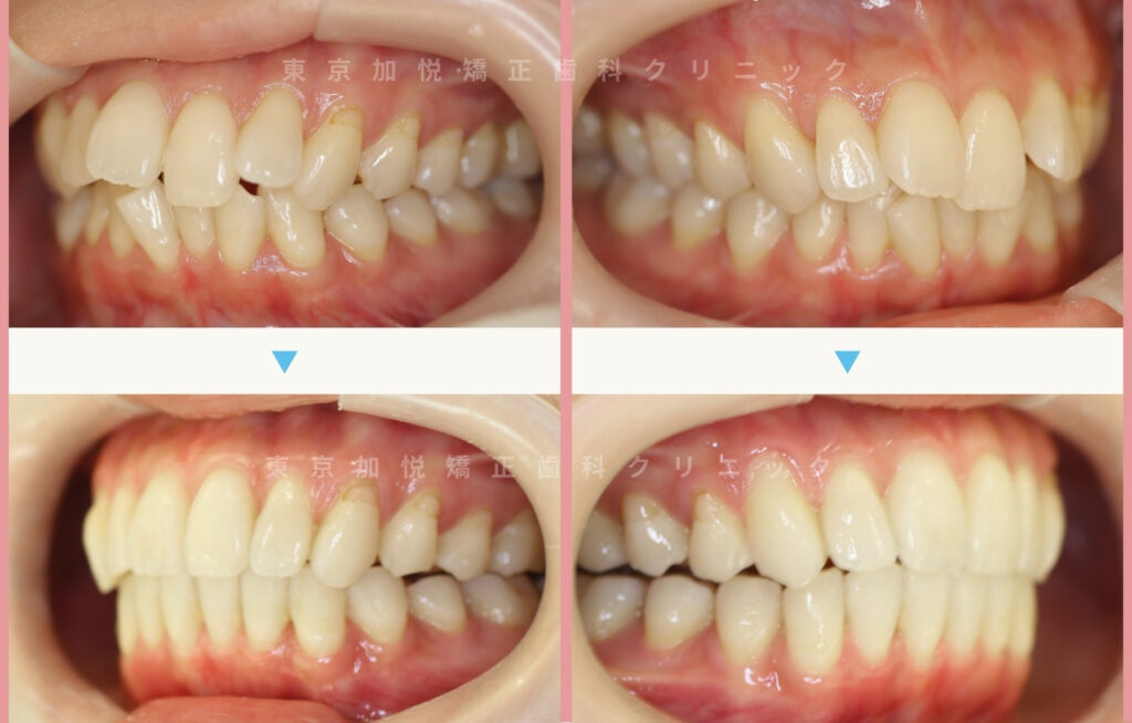 歯を抜かないで矯正した症例の横顔写真（上下の前歯を矯正）