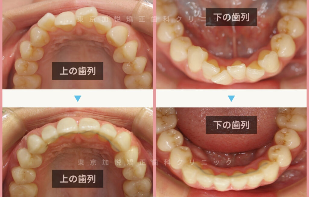 歯を抜かないで矯正した症例の咬合面写真（上下の前歯を矯正）