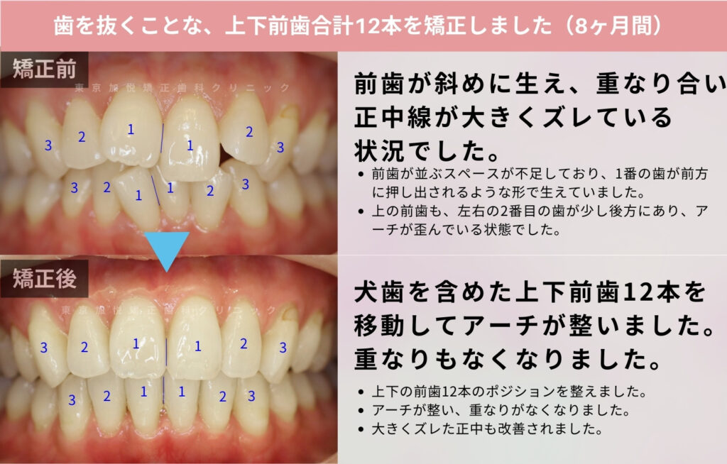 歯を抜かないで矯正した症例の正面写真（上下の前歯を矯正）