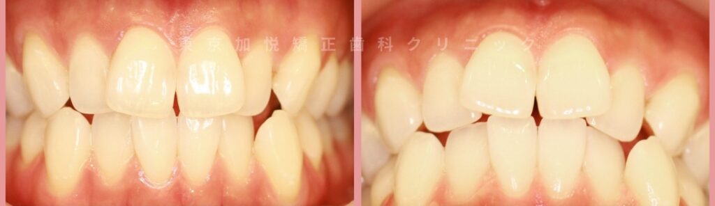 治療前写真(前歯のねじれやガタツキ)