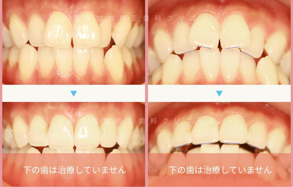 歯を抜かないで矯正した症例の正面写真(前歯のみ矯正)