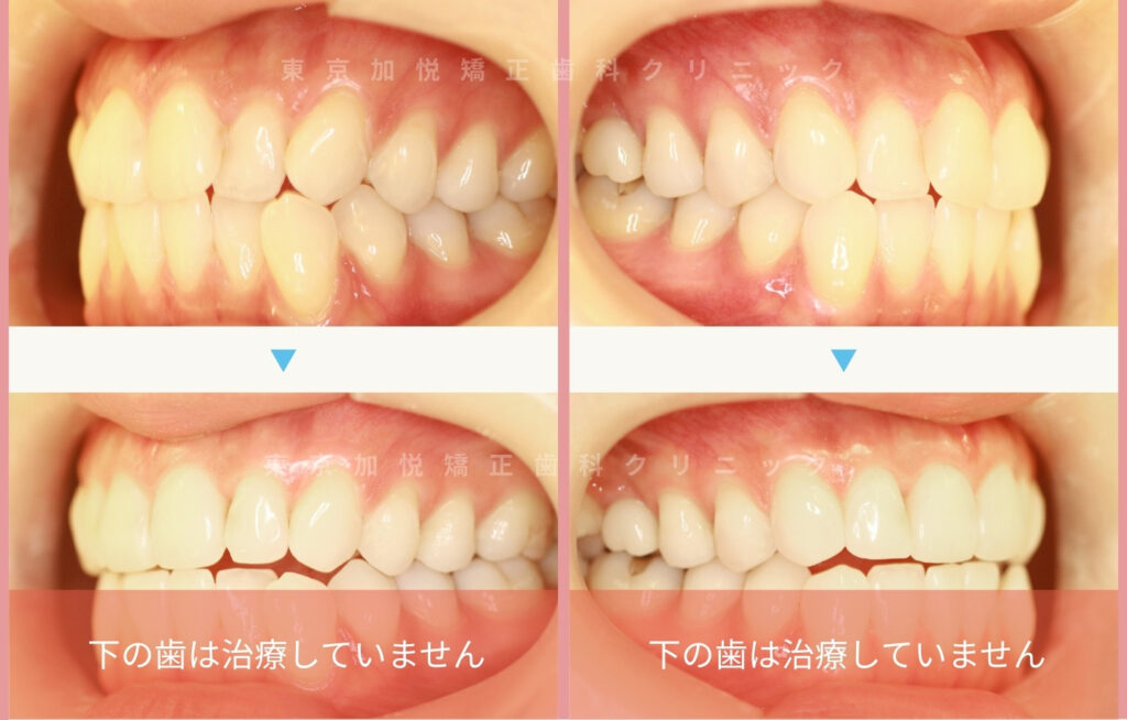 歯を抜かないで矯正した症例の横側写真(前歯のみ矯正)