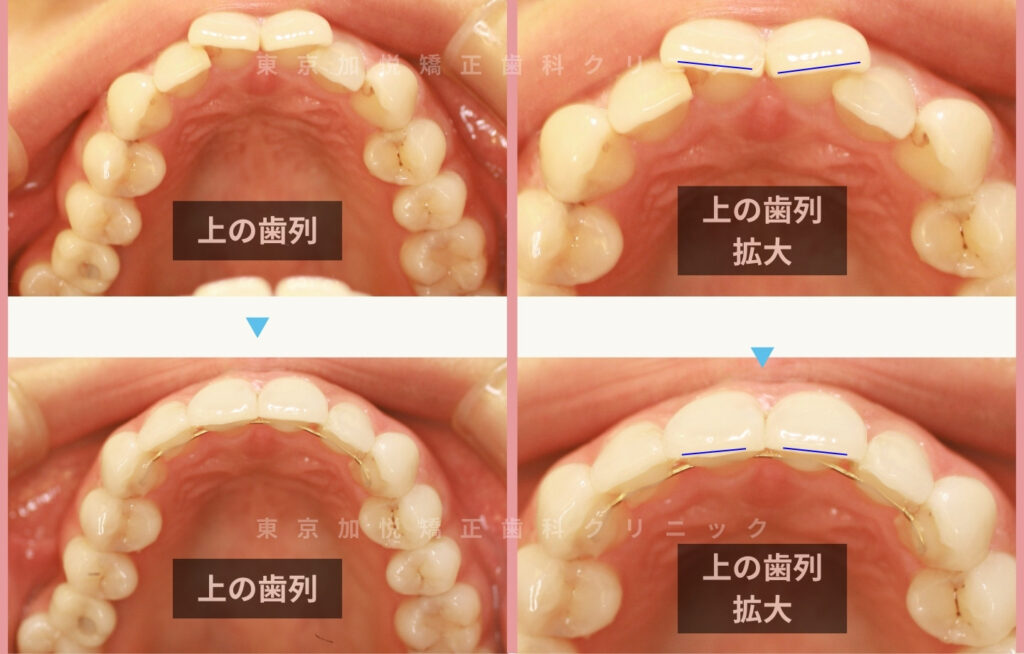歯を抜かないで矯正した症例の咬合面写真(前歯のみ矯正)