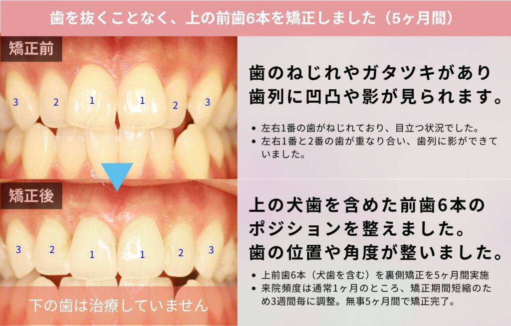 歯を抜かない矯正治療の前後写真。犬歯を含めた前歯を矯正。