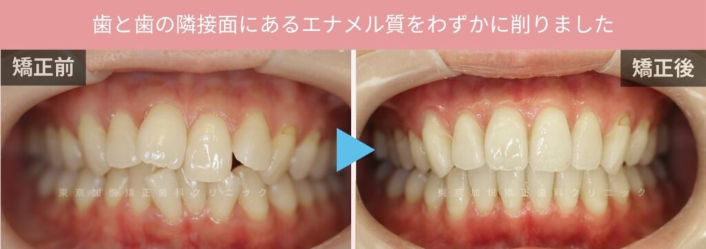 歯を抜かないで部分矯正した場合の写真。歯と歯の隣接面にあるエナメル質をわずかに削りました（ディスキング解説）