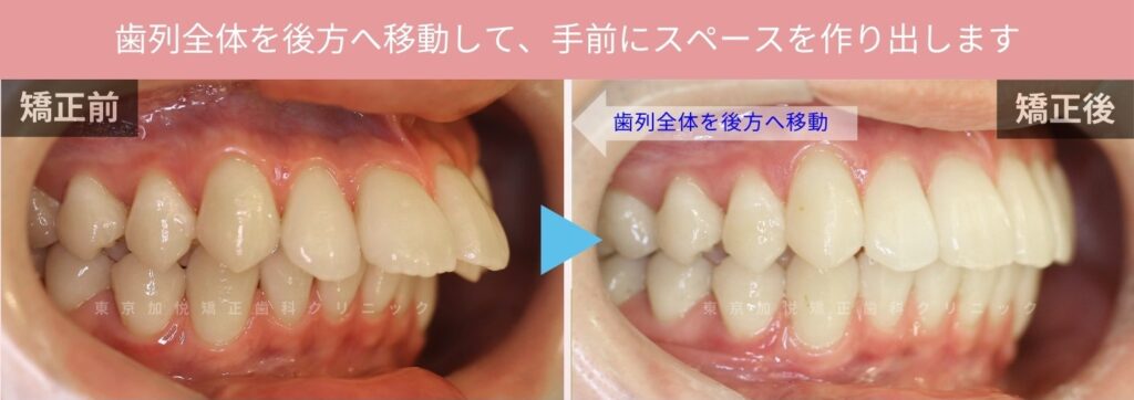 めの固定として、アンカーインプラントを使
