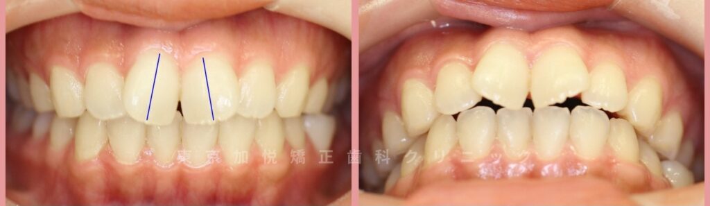 初診ご来院時のお口元正面写真（前歯2本が目立つ）