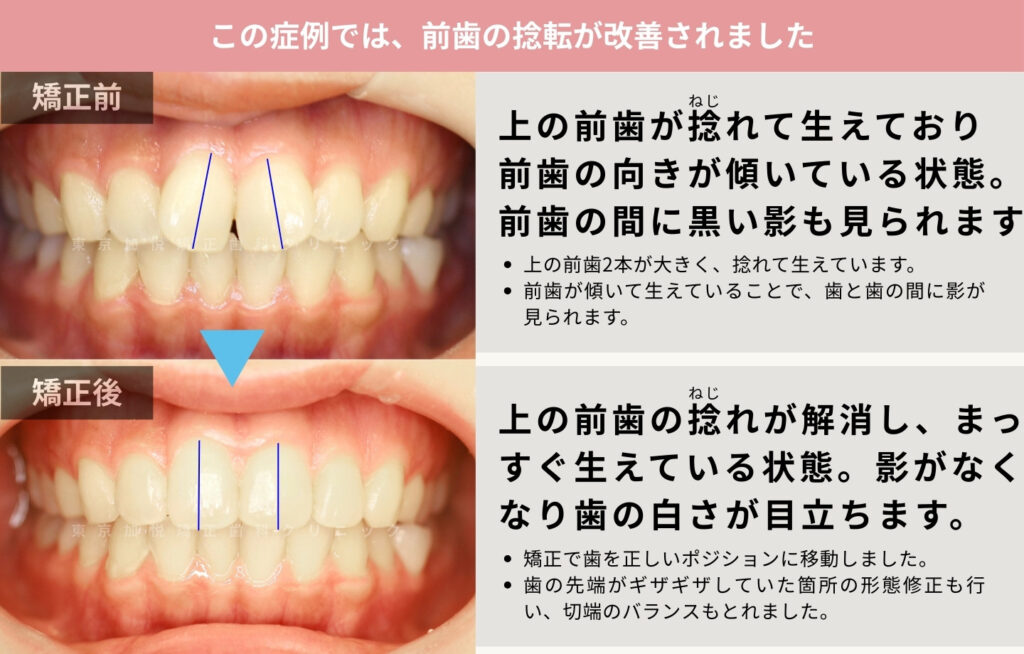 矯正治療前後写真：捻れた前歯が部分矯正でしっかりまっすぐ生えている状態になった写真
