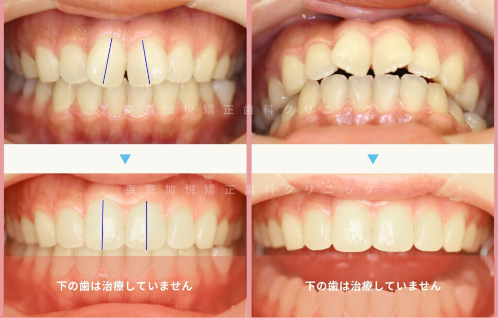 矯正治療前後写真：正面