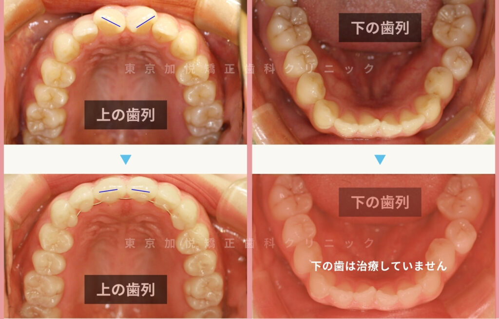 矯正治療前後写真：咬合面