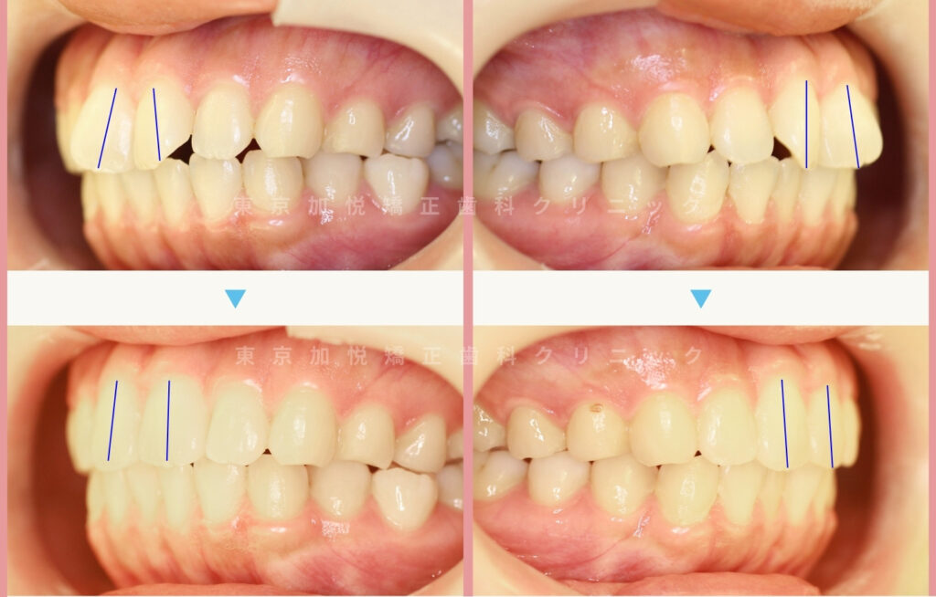 矯正治療前後写真：側面