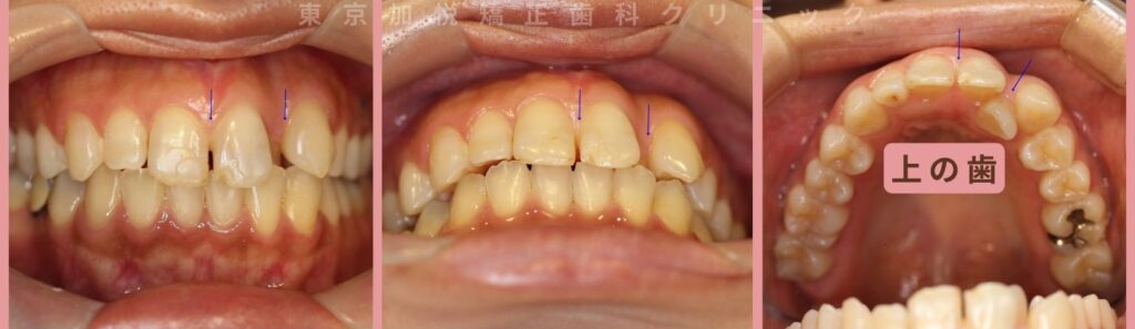 前歯の重なりとすき間が気になると来院された患者様の写真