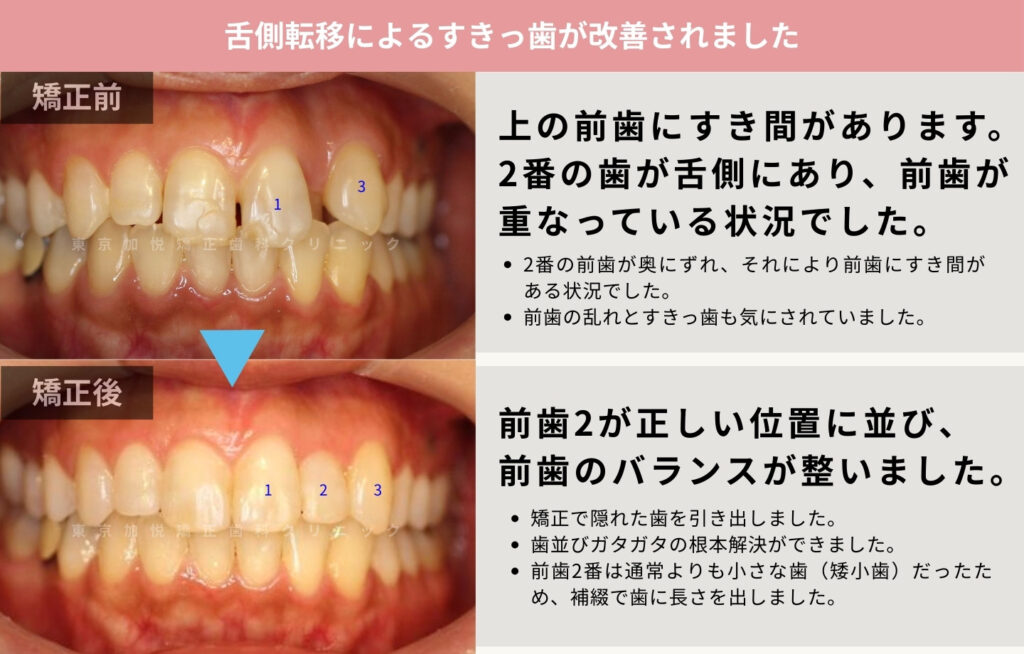 すきっ歯を前歯の矯正で治療した症例